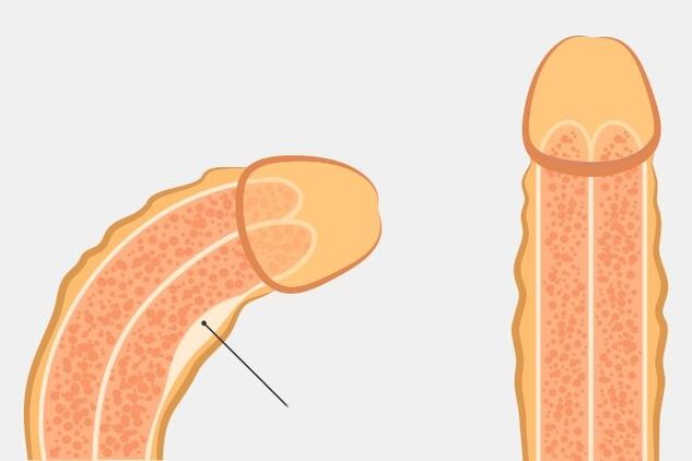 Effective ways to straighten your penis