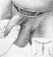 Surgery to lengthen the penis by pulling out the hidden part